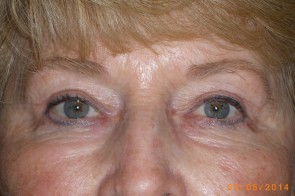 Upper and Lower Eyelid Blepharoplasty with Laser Resurfacing