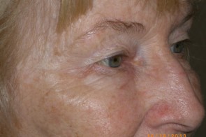 Upper and Lower Eyelid Blepharoplasty with Laser Resurfacing