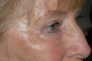 Upper and Lower Eyelid Blepharoplasty with Laser Resurfacing