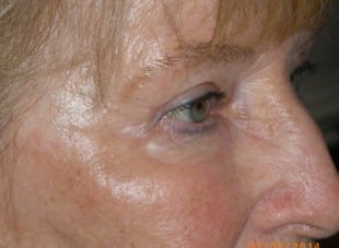 Patient 70 - After View 