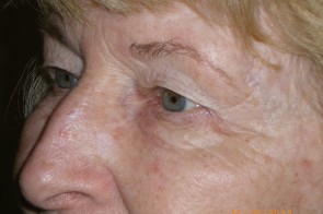 Upper and Lower Eyelid Blepharoplasty with Laser Resurfacing