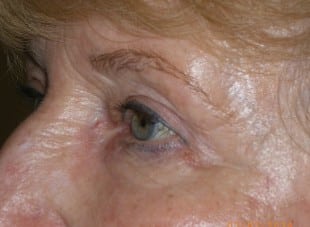 Patient 70 - After View 