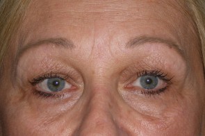 Upper and Lower Eyelid Blepharoplasty with Laser Resurfacing