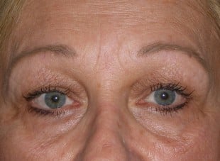 Patient 78 - Before View 
