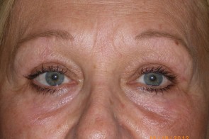 Upper and Lower Eyelid Blepharoplasty with Laser Resurfacing