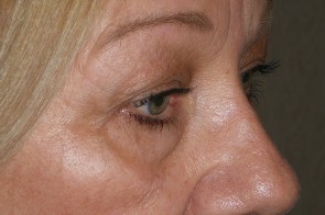 Upper and Lower Eyelid Blepharoplasty with Laser Resurfacing