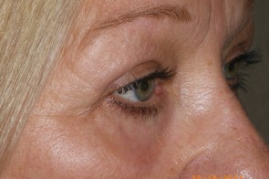 Upper and Lower Eyelid Blepharoplasty with Laser Resurfacing