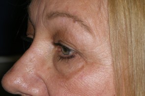 Upper and Lower Eyelid Blepharoplasty with Laser Resurfacing