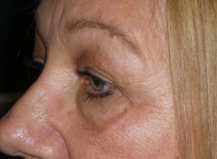 Patient 78 - Before View 
