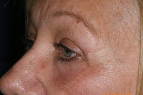 Upper and Lower Eyelid Blepharoplasty with Laser Resurfacing