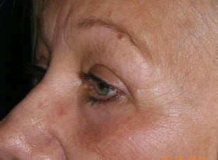 Patient 78 - After View 