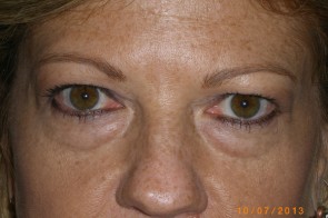 Upper and Lower Eyelid Blepharoplasty with Laser Resurfacing