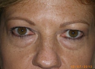 Patient 82 - Before View 