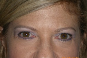 Upper and Lower Eyelid Blepharoplasty with Laser Resurfacing