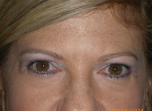 Patient 82 - After View 