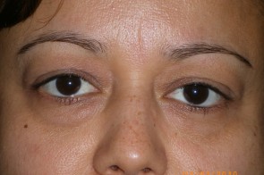 Upper and Lower Eyelid Blepharoplasty with Laser Resurfacing