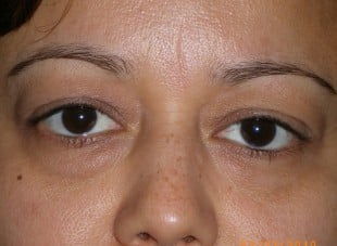 Patient 85 - Before View 