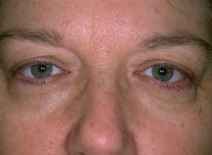Patient 92 - Before View 