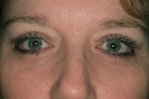 Upper and Lower Eyelid Blepharoplasty with Laser Resurfacing