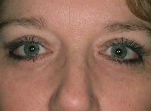 Patient 92 - After View 