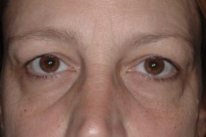 Upper and Lower Eyelid Blepharoplasty with Laser Resurfacing