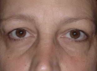 Patient 94 - Before View 