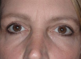 Patient 94 - After View 