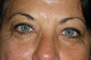 Upper and Lower Eyelid Blepharoplasty with Laser Resurfacing