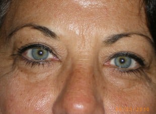 Patient 99 - Before View 