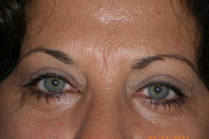 Upper and Lower Eyelid Blepharoplasty with Laser Resurfacing