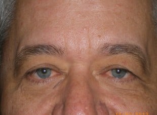 Patient 102 - Before View 