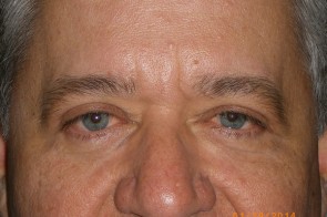 Upper and Lower Eyelid Blepharoplasty with Laser Resurfacing