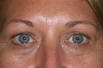 Upper and Lower Eyelid Blepharoplasty with Laser Resurfacing