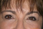 Upper and Lower Eyelid Blepharoplasty with Laser Resurfacing