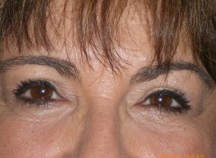 Patient 109 - After View 