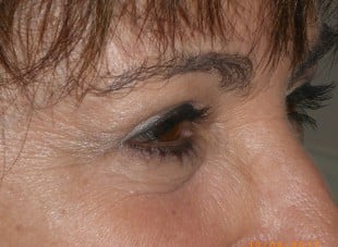 Patient 109 - After View 
