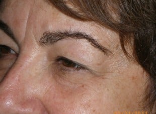 Patient 109 - Before View 