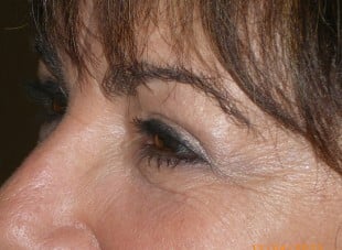 Patient 109 - After View 
