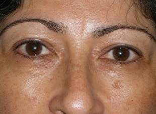 Patient 111 - Before View 