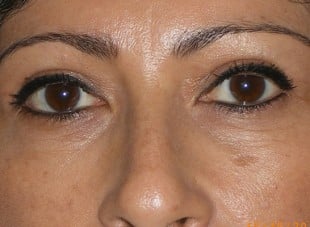 Patient 111 - After View 