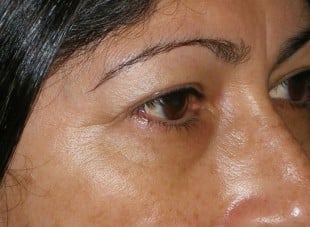 Patient 111 - Before View 