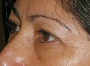 Patient 111 - Before View 