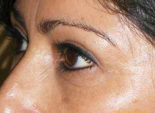 Patient 111 - After View 