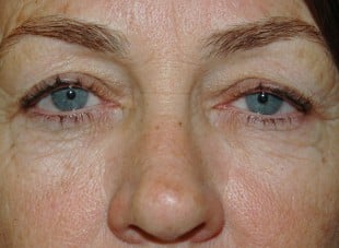 Patient 113 - Before View 