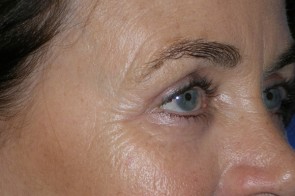 Upper and Lower Eyelid Blepharoplasty with Laser Resurfacing