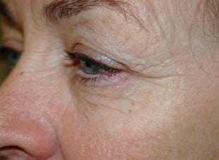 Patient 113 - Before View 