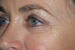 Upper and Lower Eyelid Blepharoplasty with Laser Resurfacing