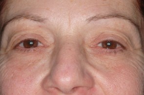 Upper and Lower Eyelid Blepharoplasty with Laser Resurfacing