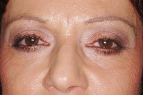 Upper and Lower Eyelid Blepharoplasty with Laser Resurfacing