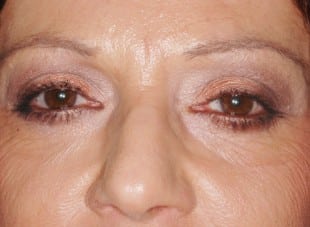 Patient 115 - After View 